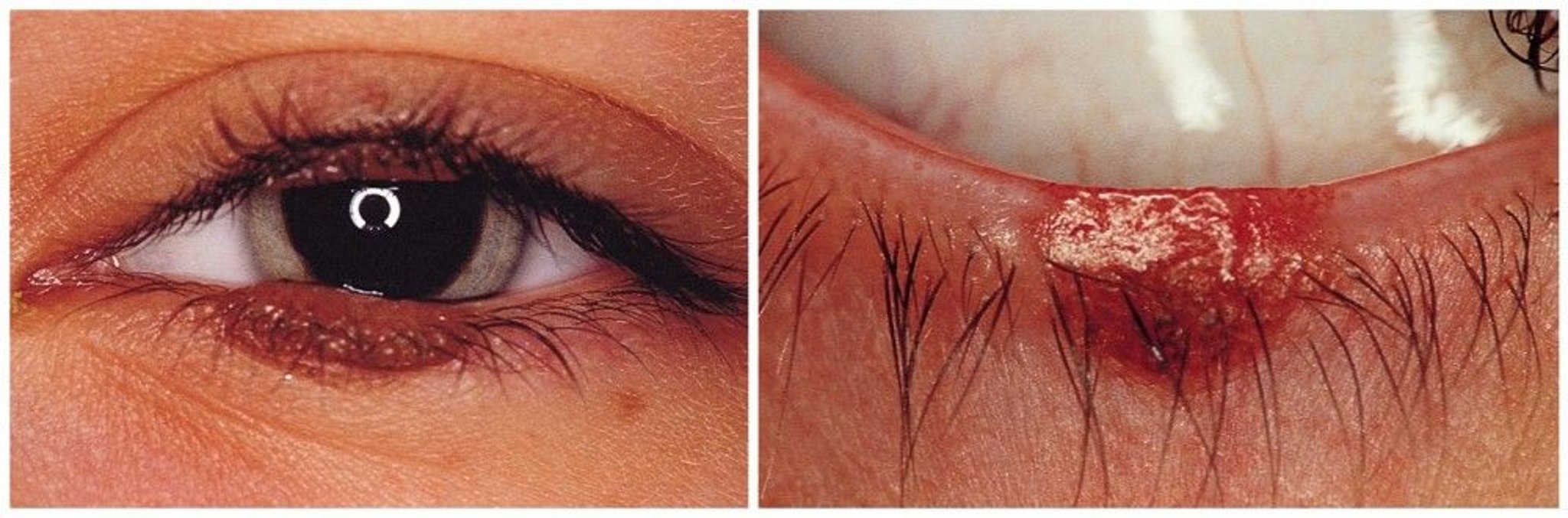 Tahi Lalat di Dekat Mata