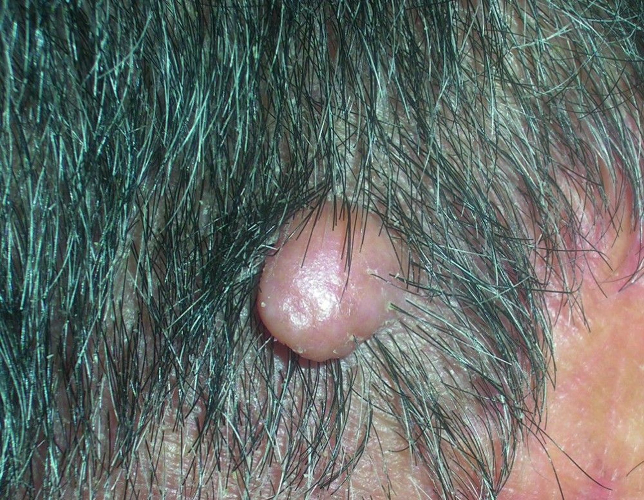 Mole on the Scalp