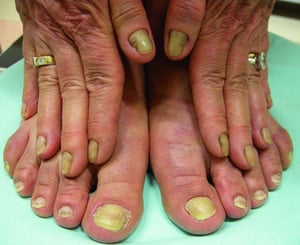 Yellow Nail Syndrome