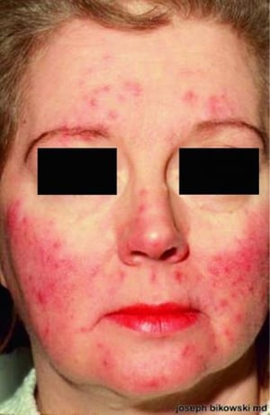 Rosacea infiammatoria