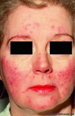 Inflammatory Rosacea