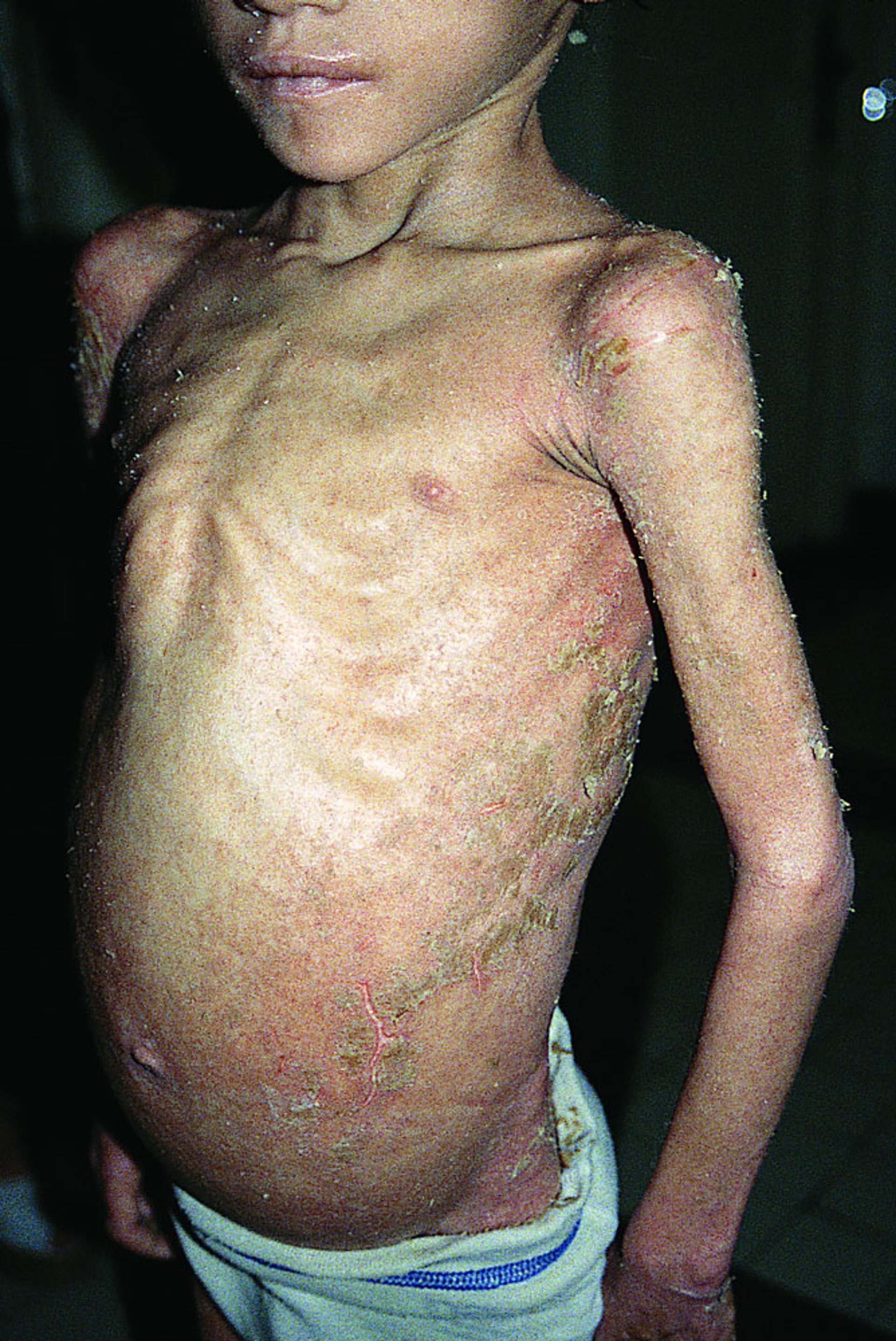 Crusted Scabies (Norwegian Scabies)