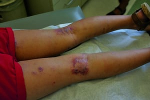 Dermatite atopica (parte posteriore delle ginocchia)