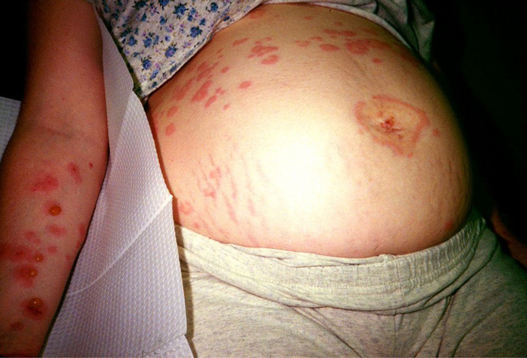 Polymorphe Schwangerschaftsdermatose