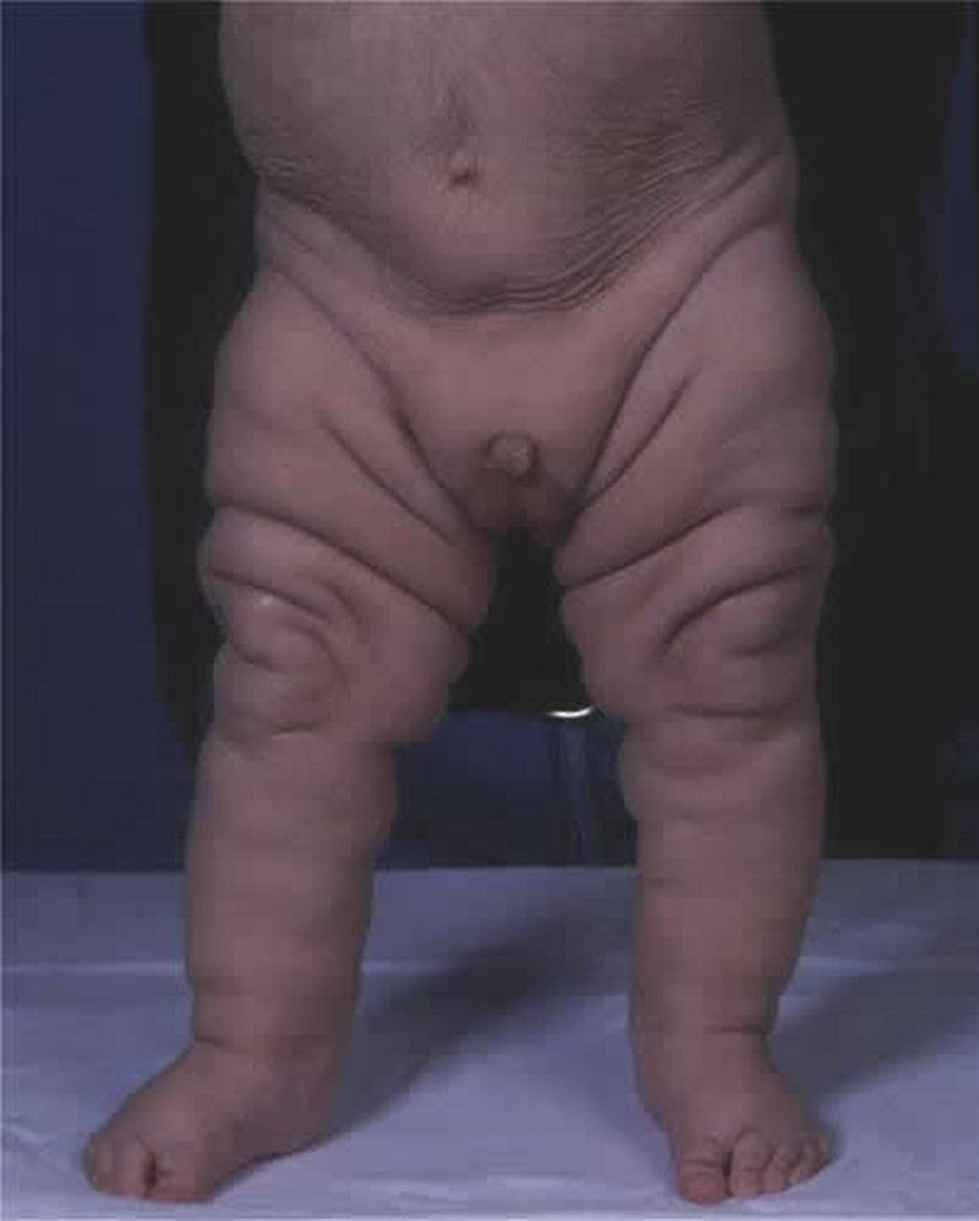 Cutis Laxa