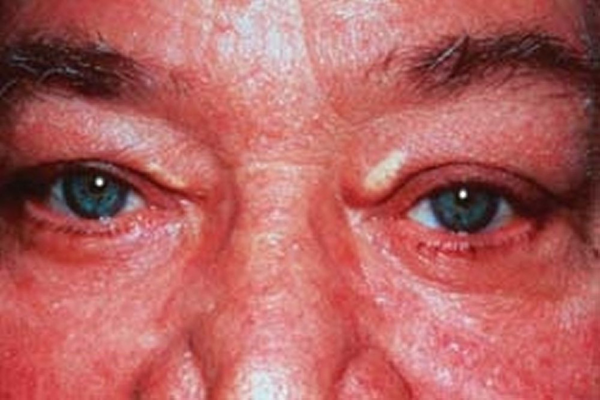 Xanthelasma (الجفن)