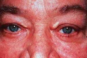 眼瞼黄色腫がんけんおうしょくしゅ（まぶた）