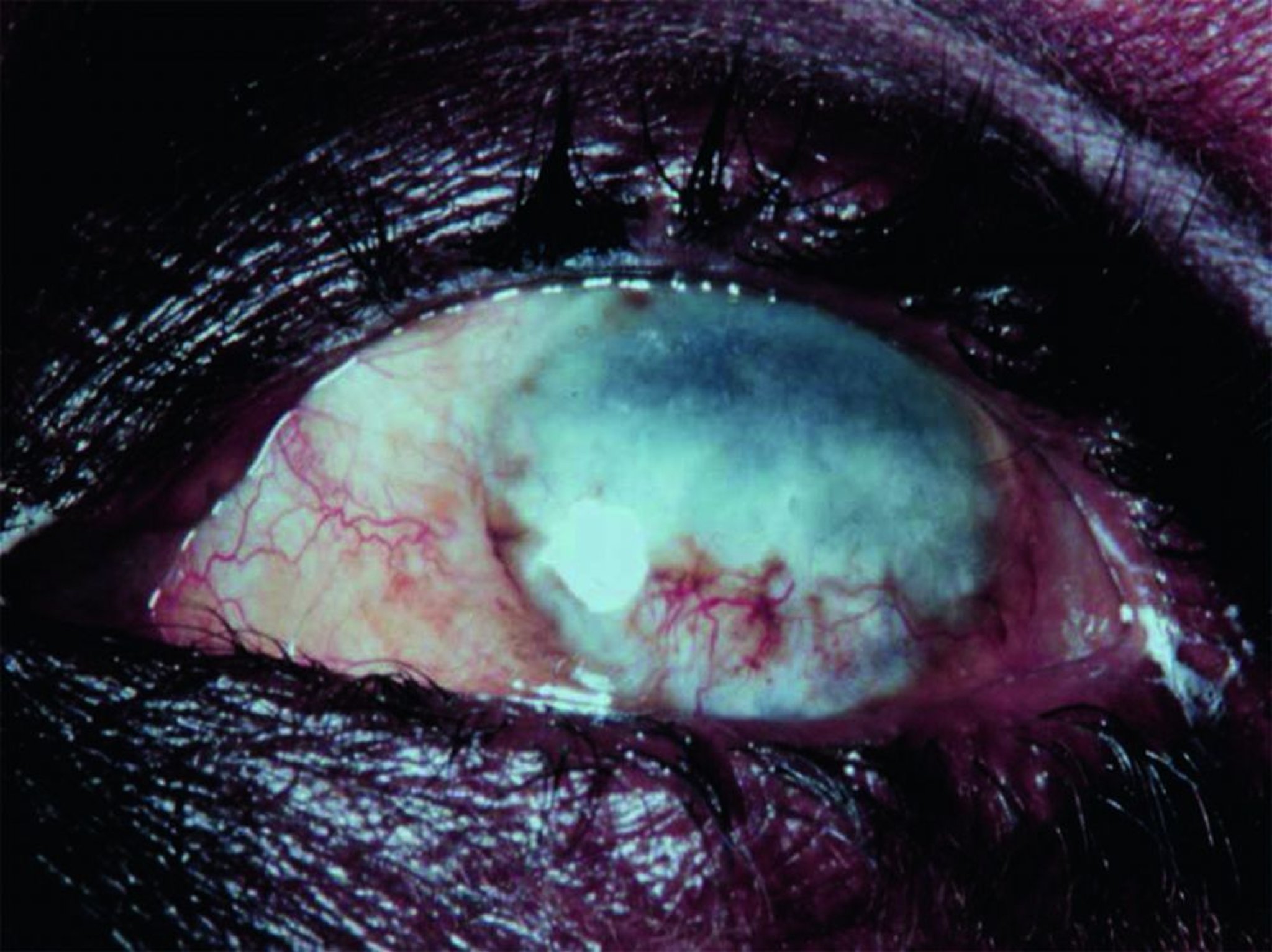 Cicatrización del ojo debida a la oncocercosis