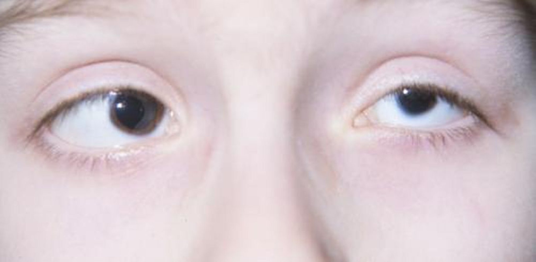 माइक्रोफ़्थैल्मिया