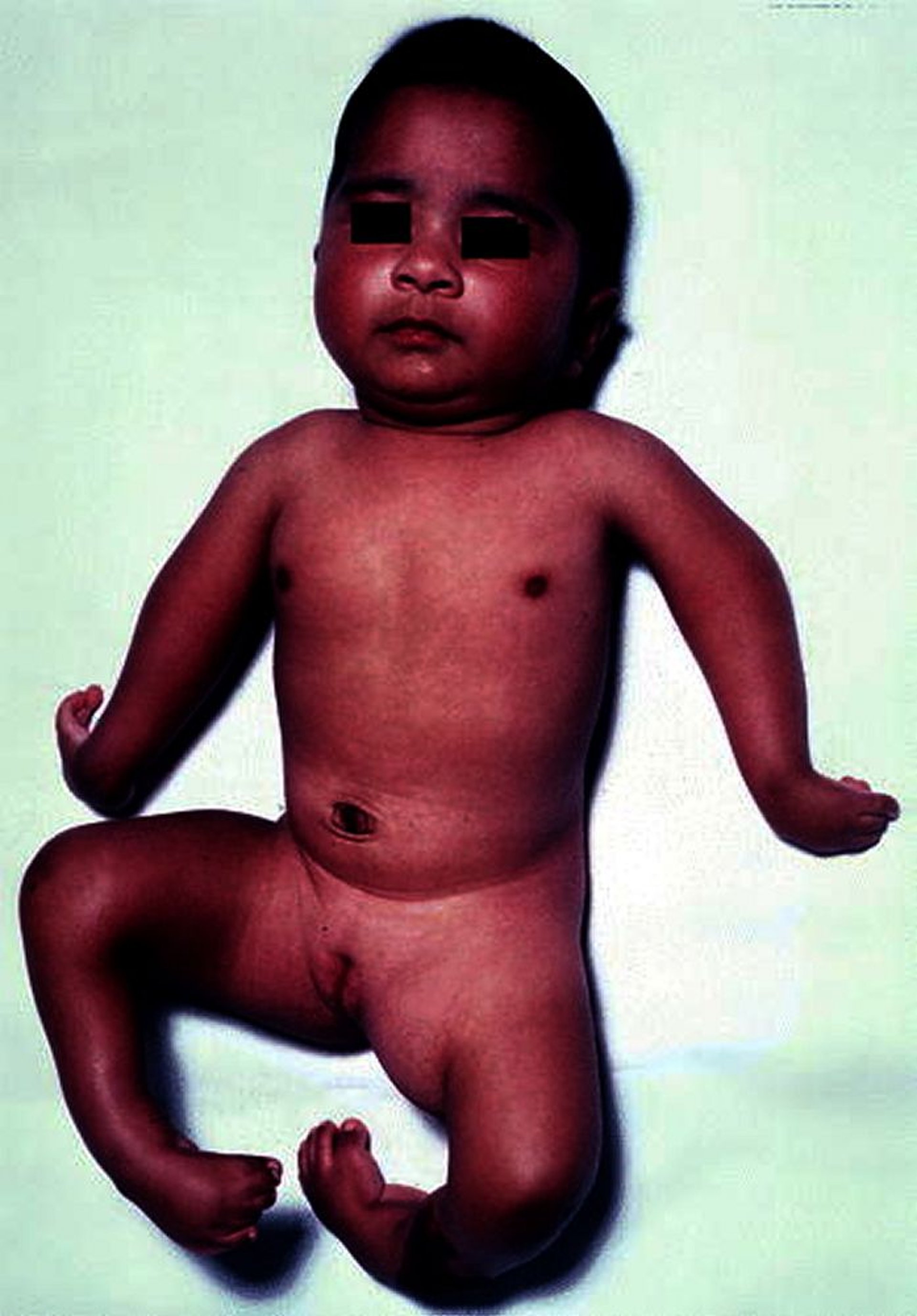 اعوِجاجُ المَفاصِلِ الخِلقِيُّ المُتَعَدِّد