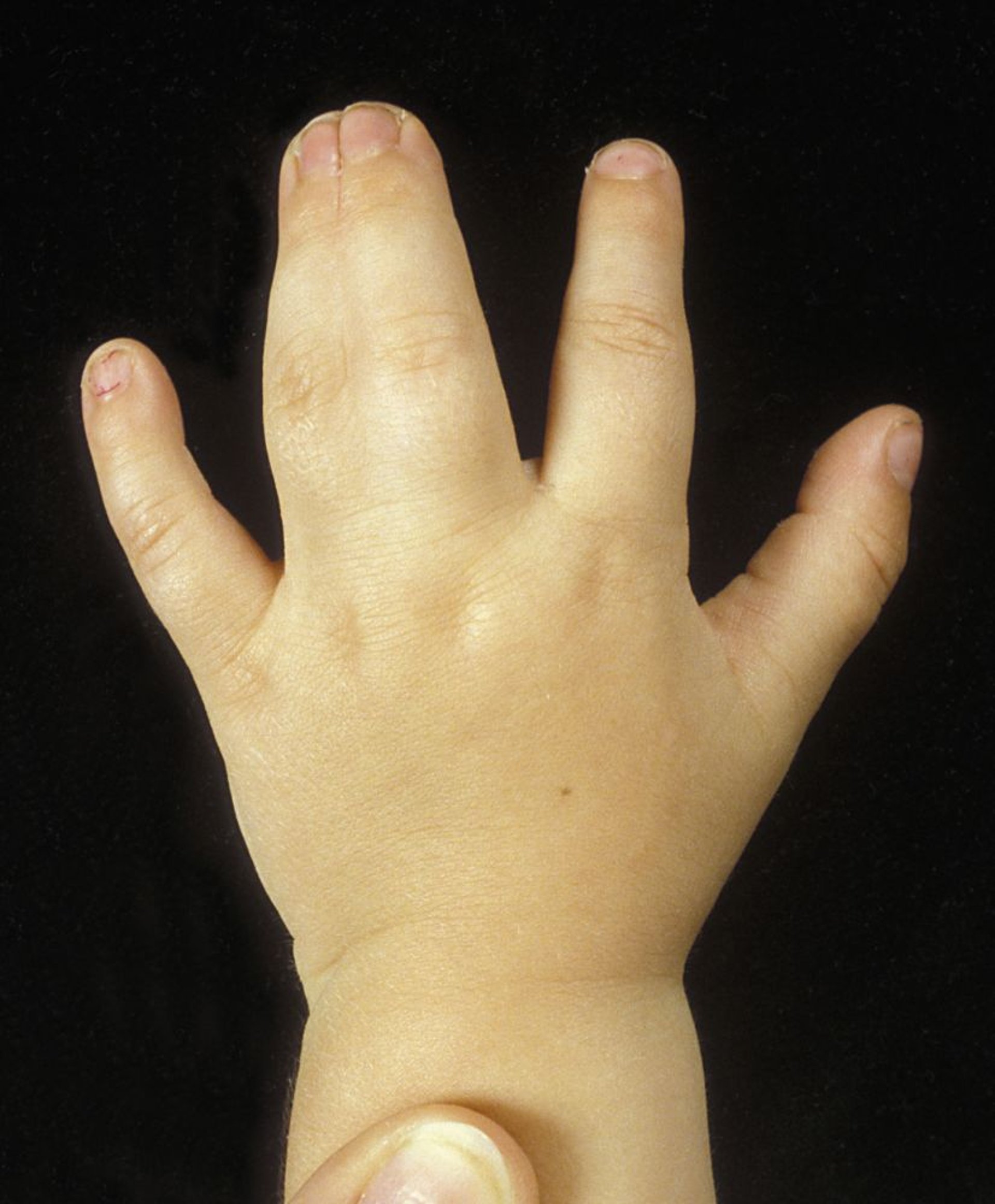 Sindactilia complexa da mão