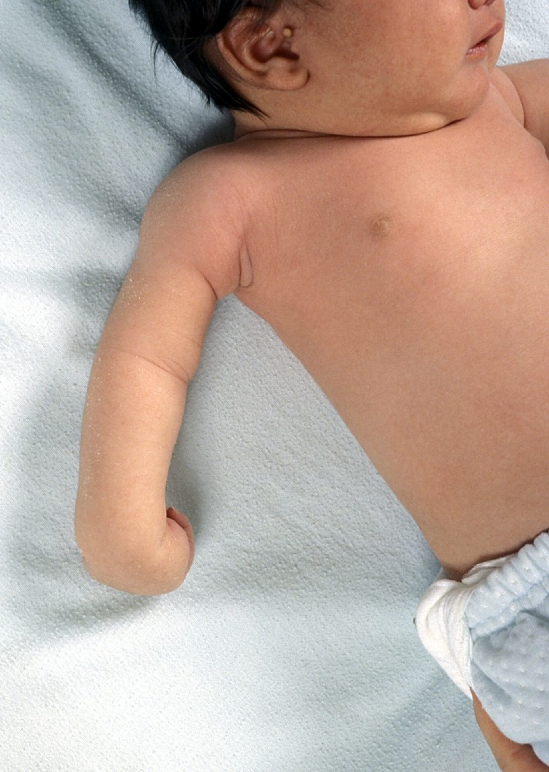 Erb Palsy in an Infant