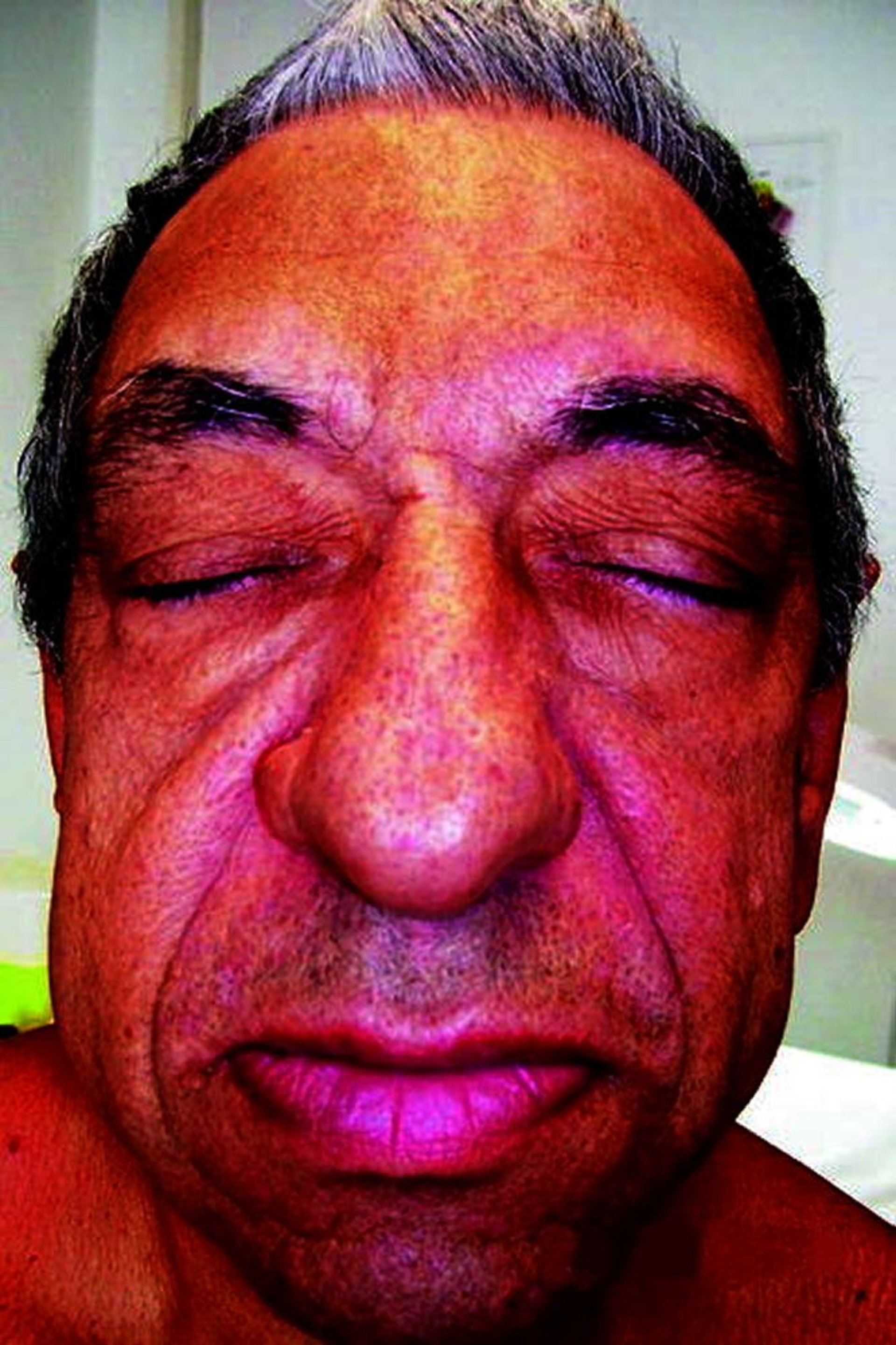 ضخامة النِّهايات acromegaly