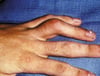 Boutonnière Deformity