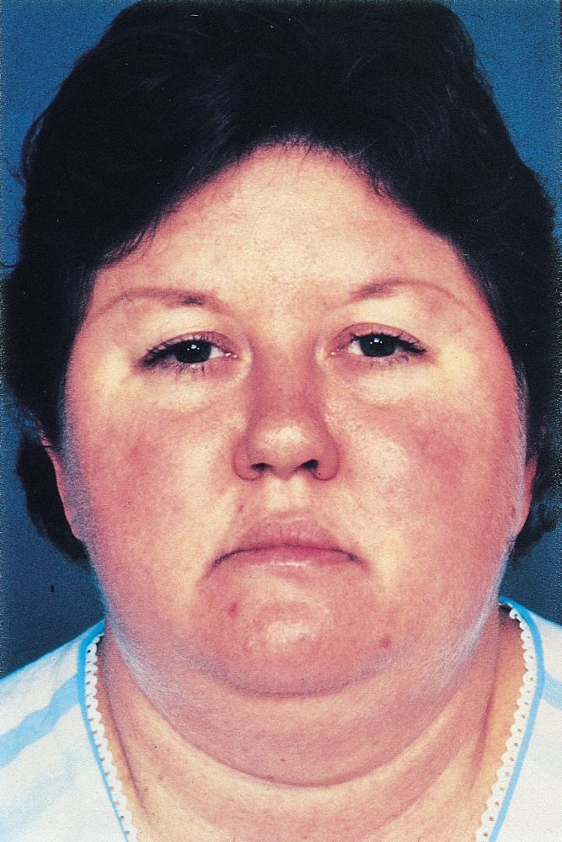 Syndrome de Cushing (caractéristiques faciales)