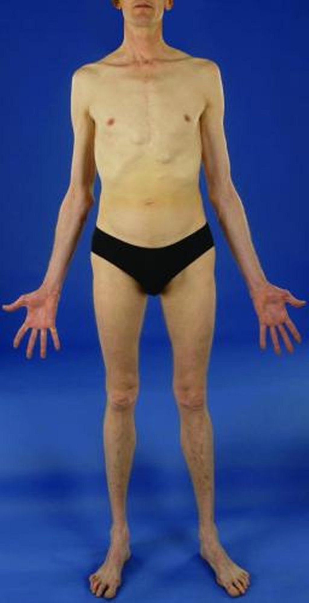 马凡氏综合征（肌肉骨骼异常）