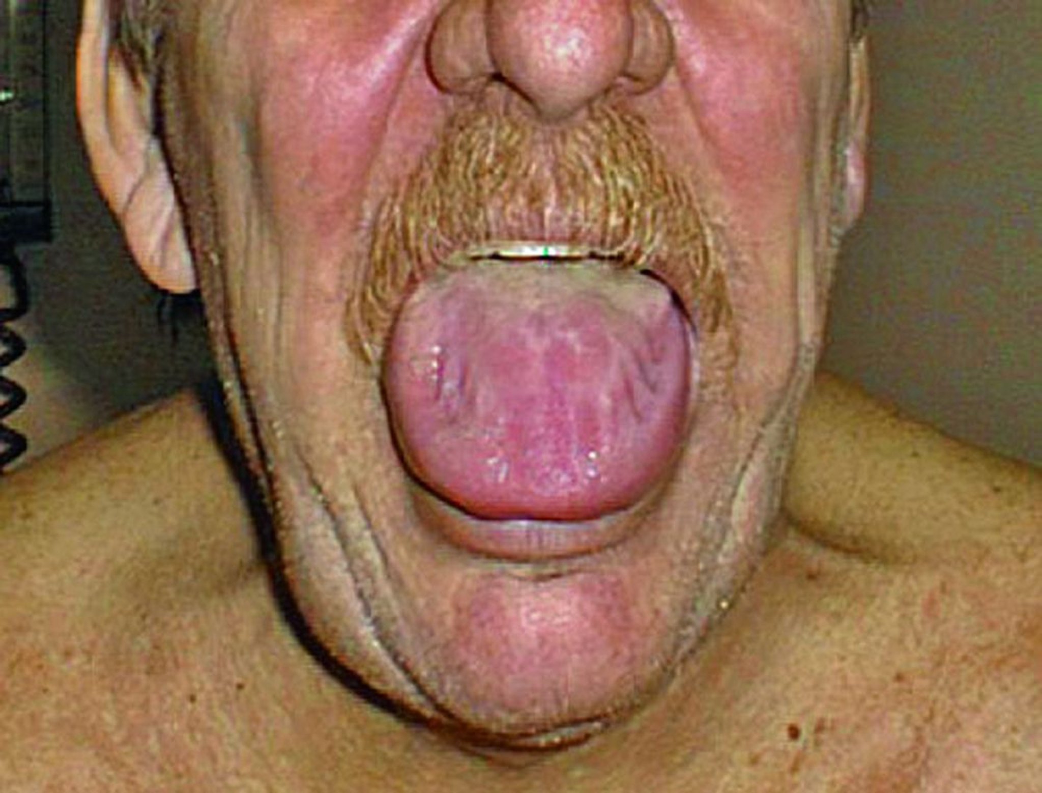 Macroglosia (lengua agrandada)