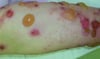 Bullous Pemphigoid on the Arm