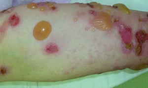 Pemphigoïde bulleuse sur le bras