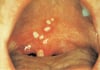 Herpangine