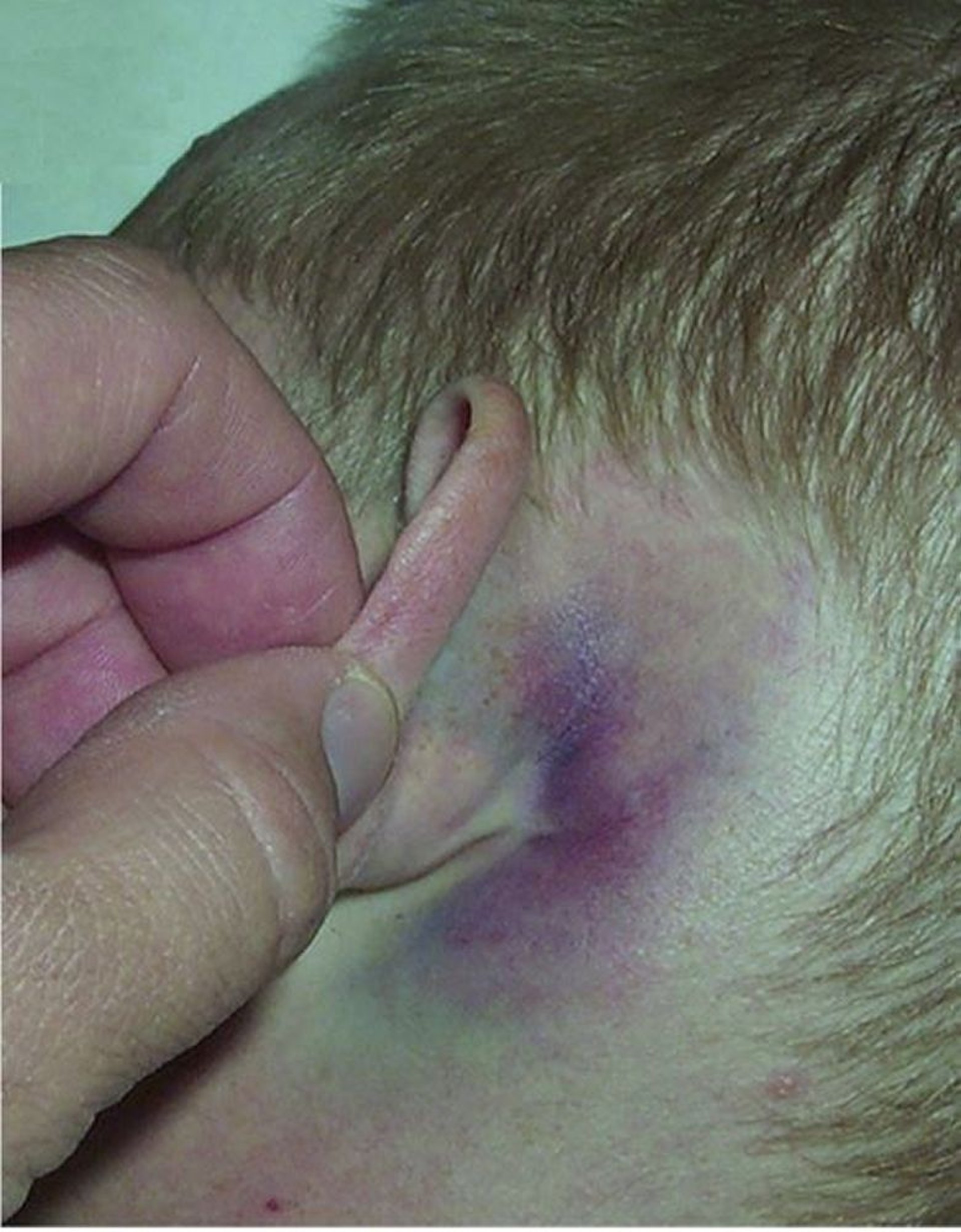 Ecchymose derrière l’oreille