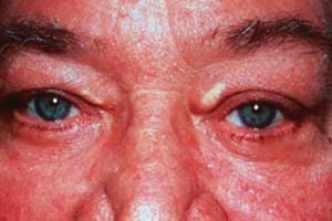 Xanthelasma (Kelopak mata)