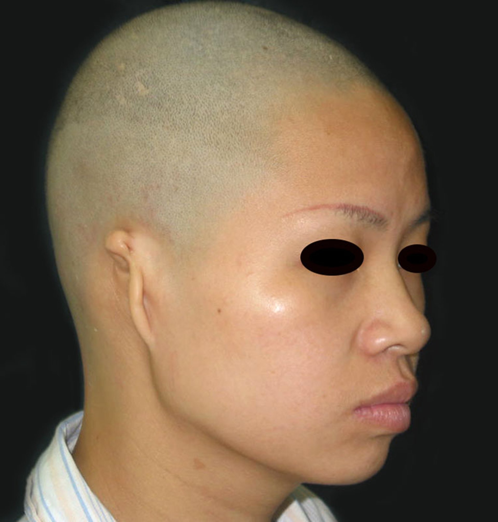 Microtia