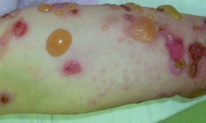 Bullous Pemphigoid kwenye Mkono