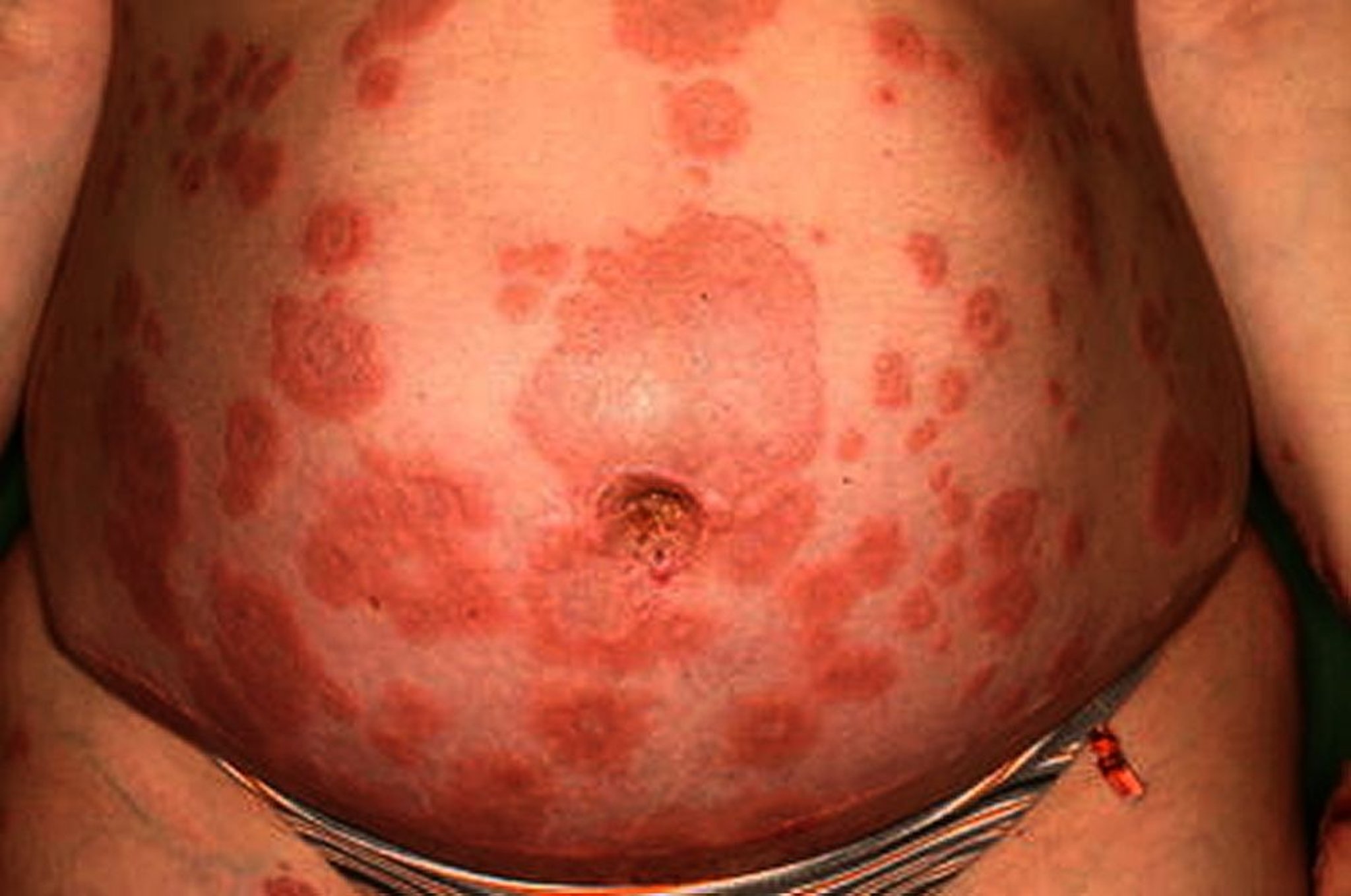 Penfigoide o herpes gestacional