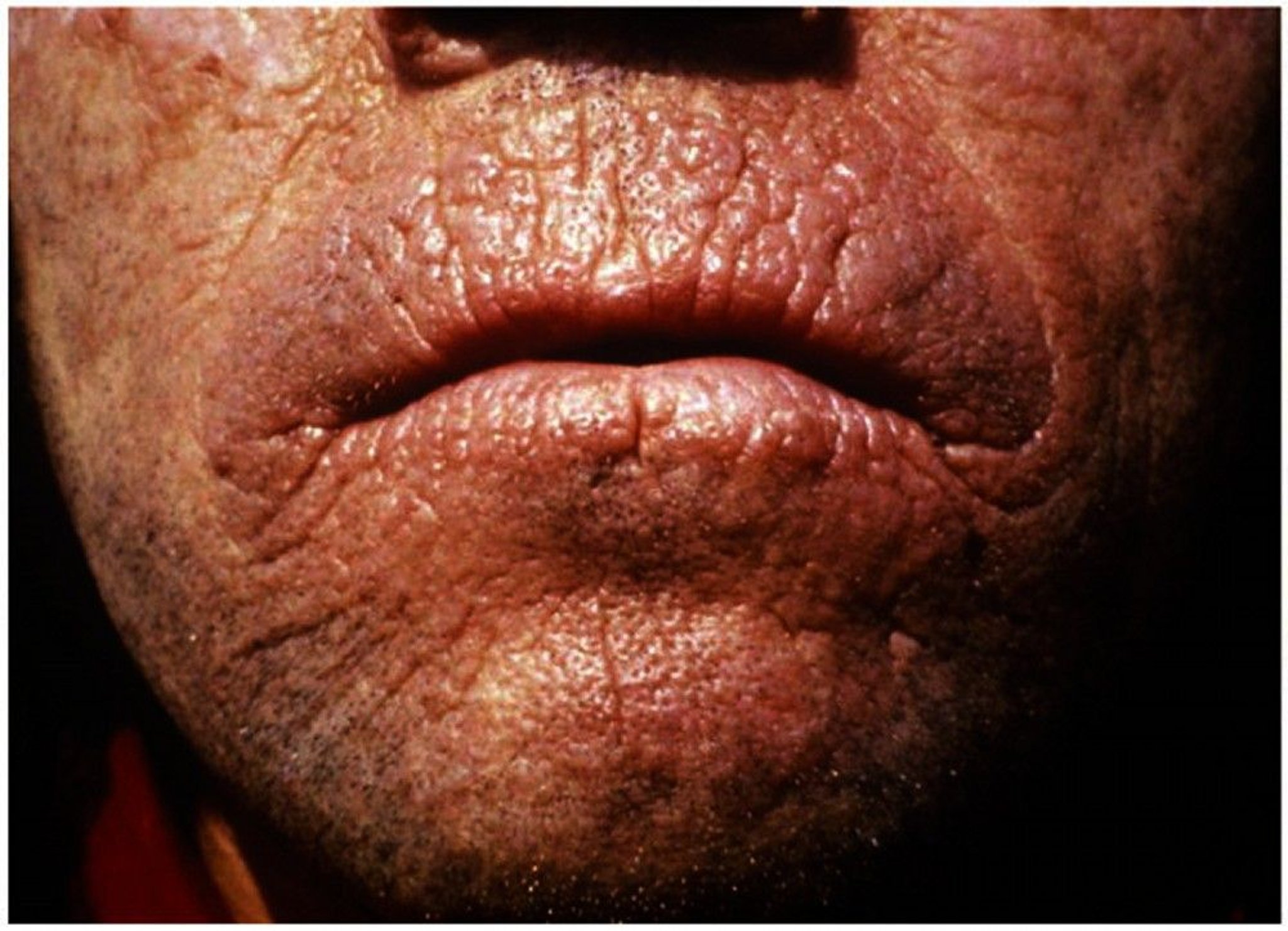 Erythropoietic Protoporphyria (Carp Mouth)