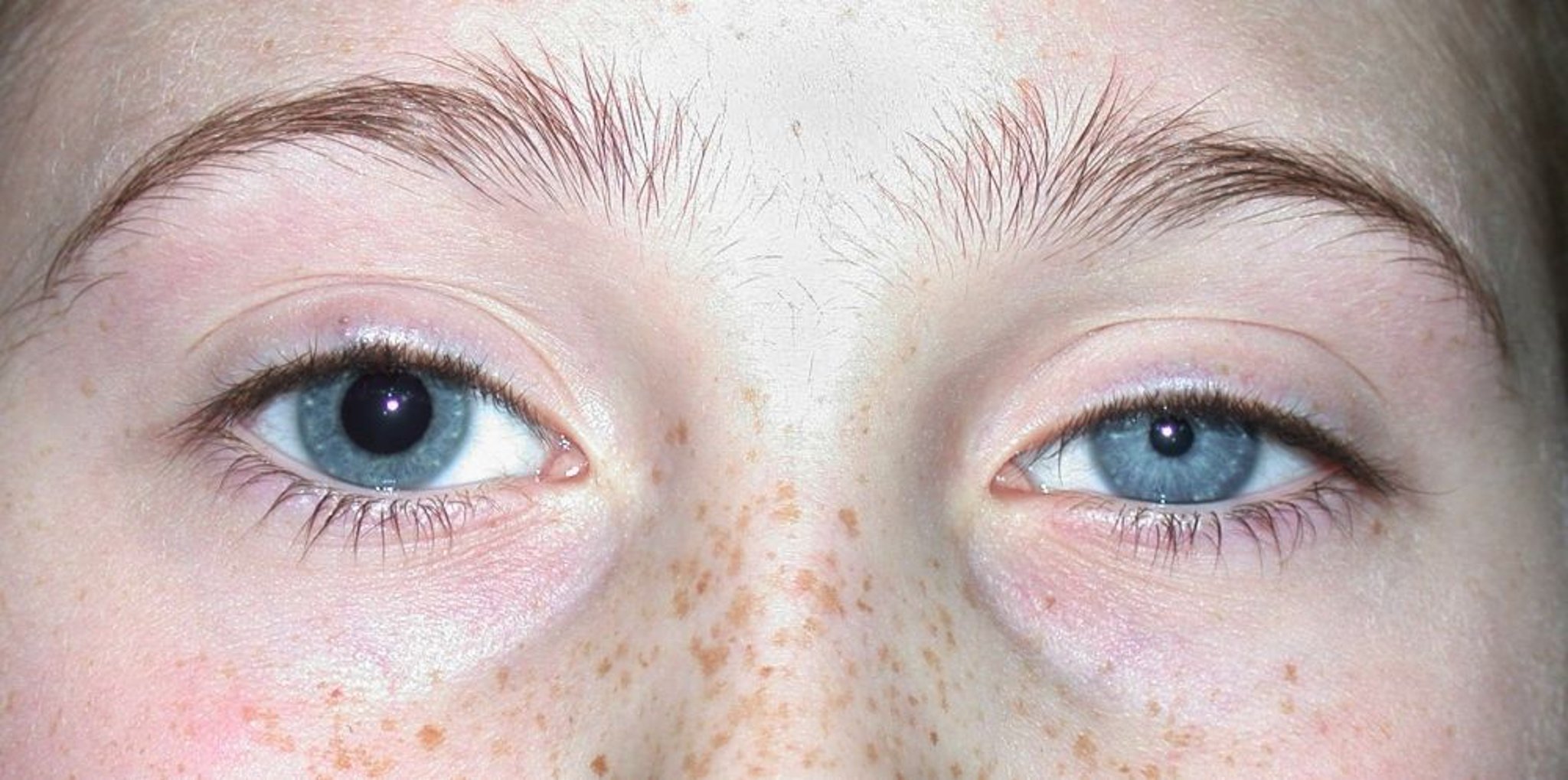 Pupilas desiguais (anisocoria)