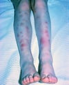 Erythema nodosum bei Morbus Behçet