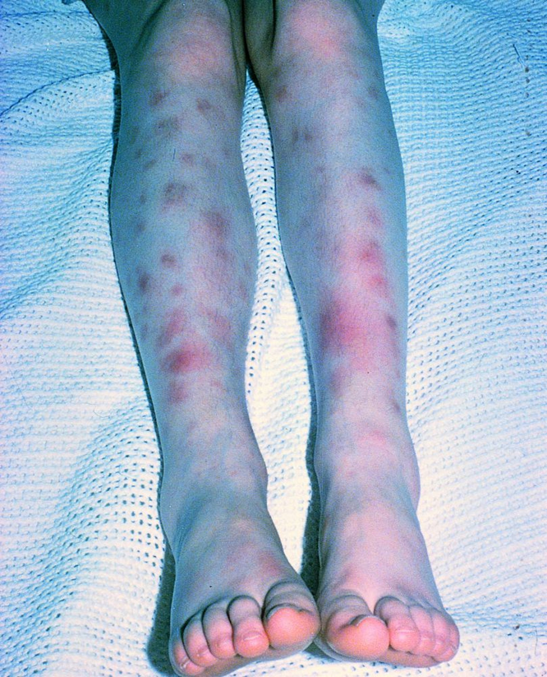 Erythema nodosum bei Morbus Behçet