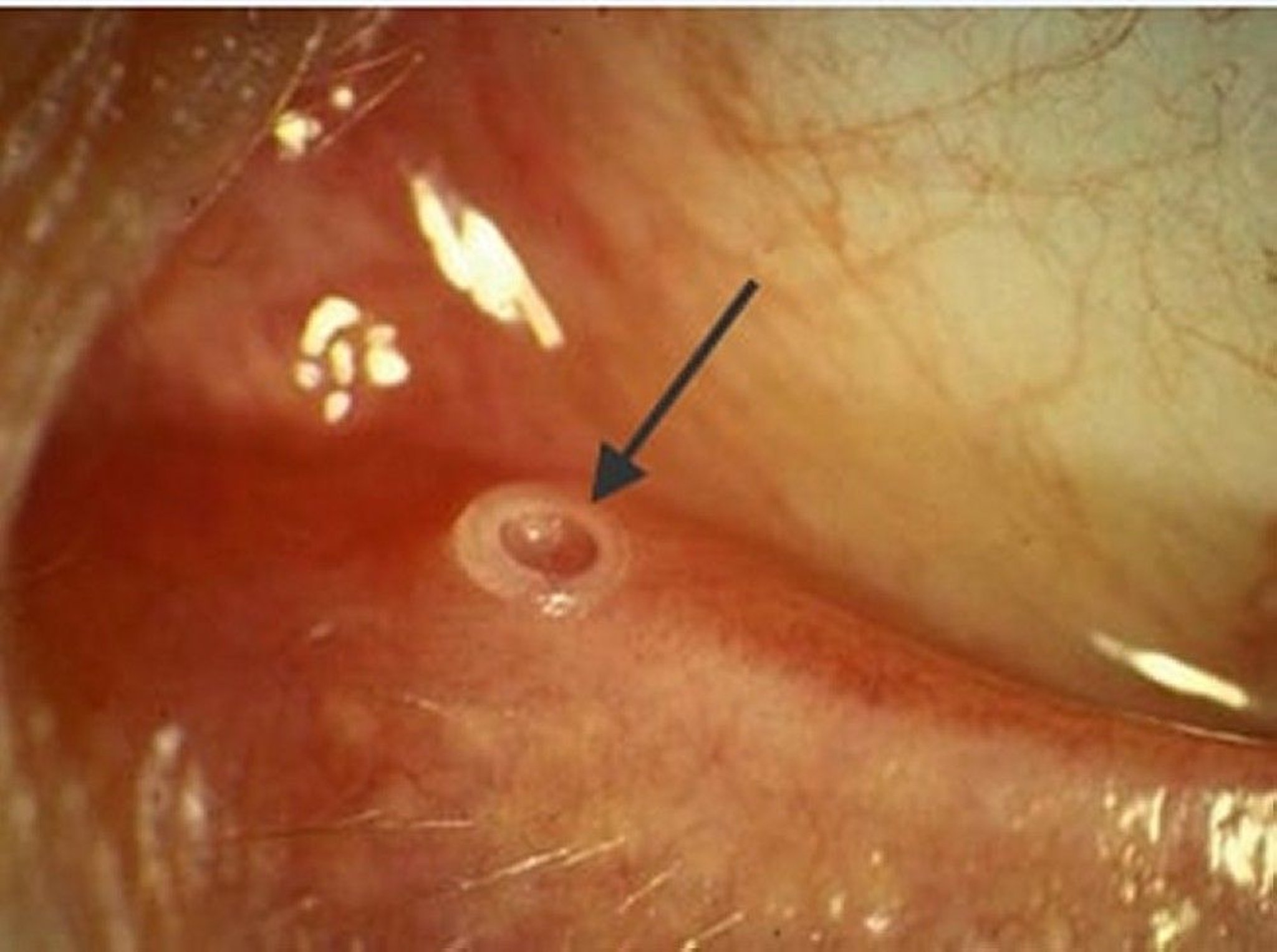Punctal Plug