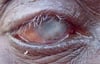 Trachoma