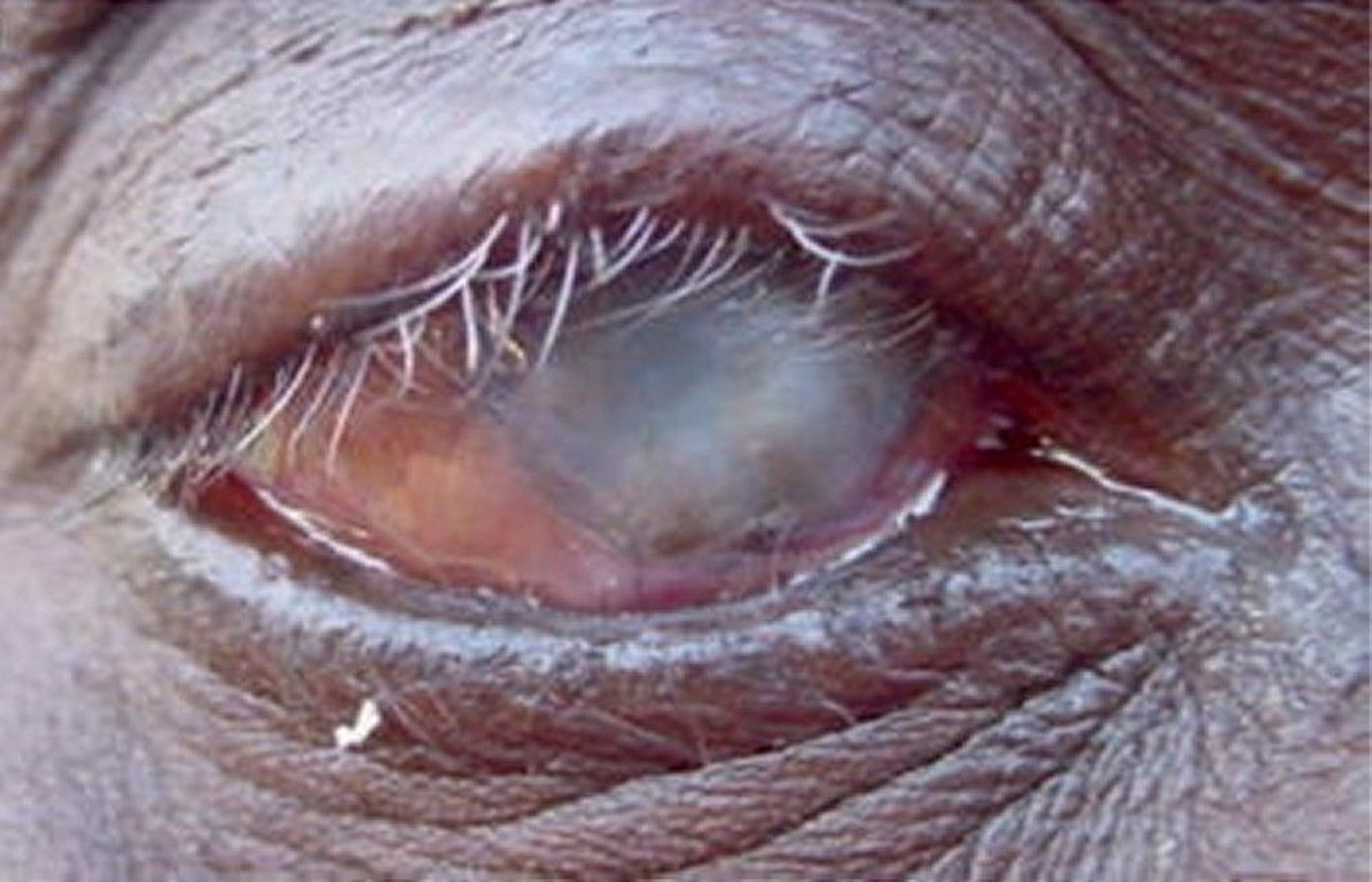 Trachoma