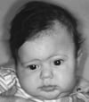 Craniosynostose de la suture coronale gauche (craniosynostose coronale)