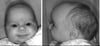 Craniosynostose de la suture sagittale (craniosynostose sagittale)
