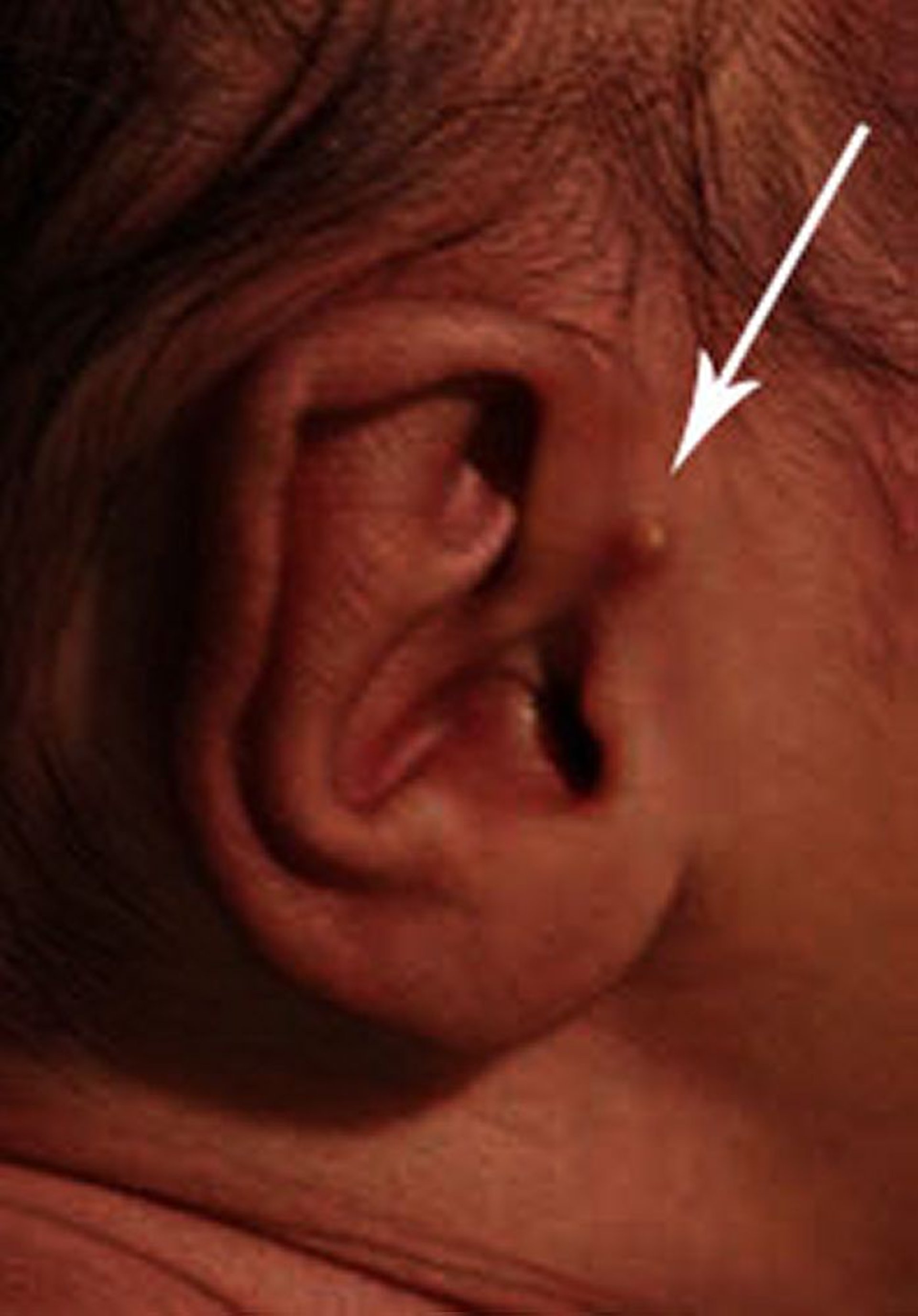 Acrochordon de l’oreille