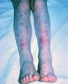 Erythema Nodosum katika Ugonjwa wa Behçet
