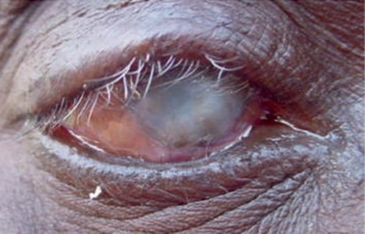 Tracoma