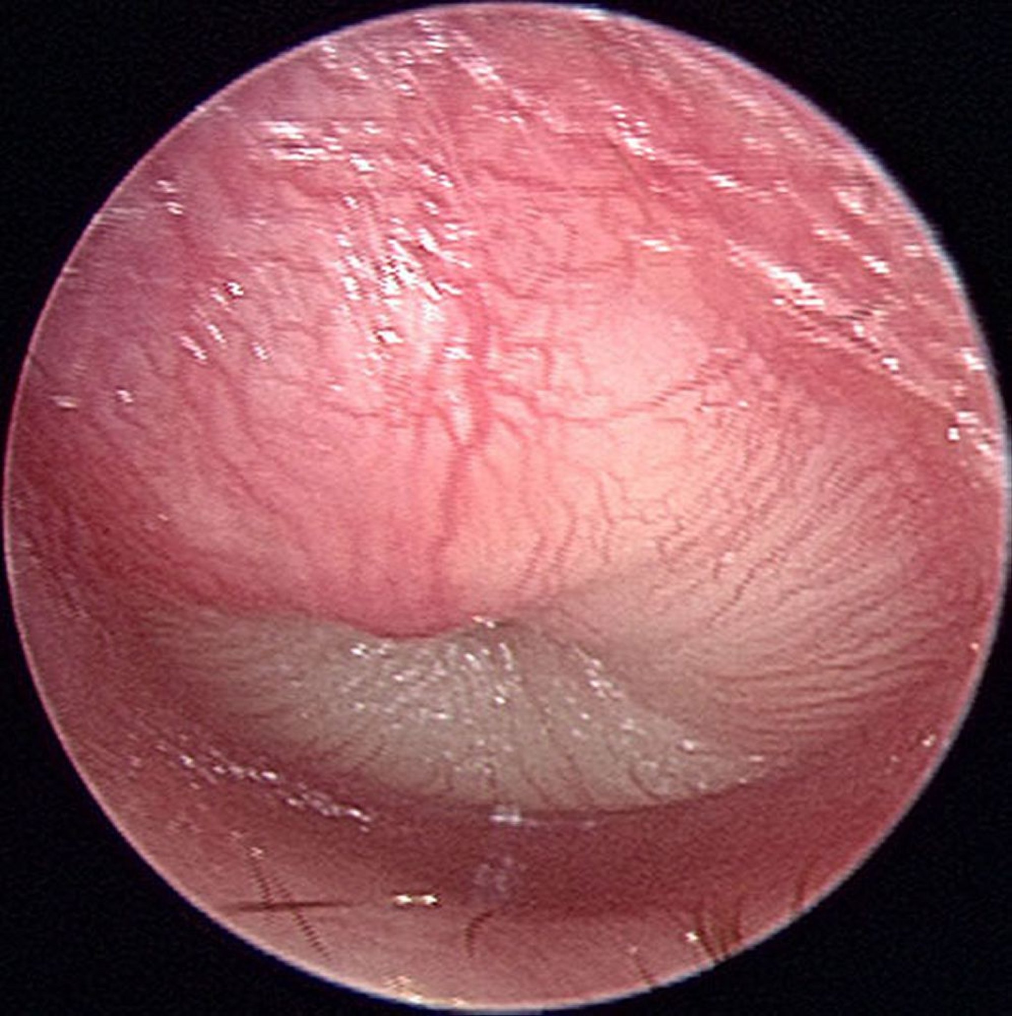 Острый средний отит