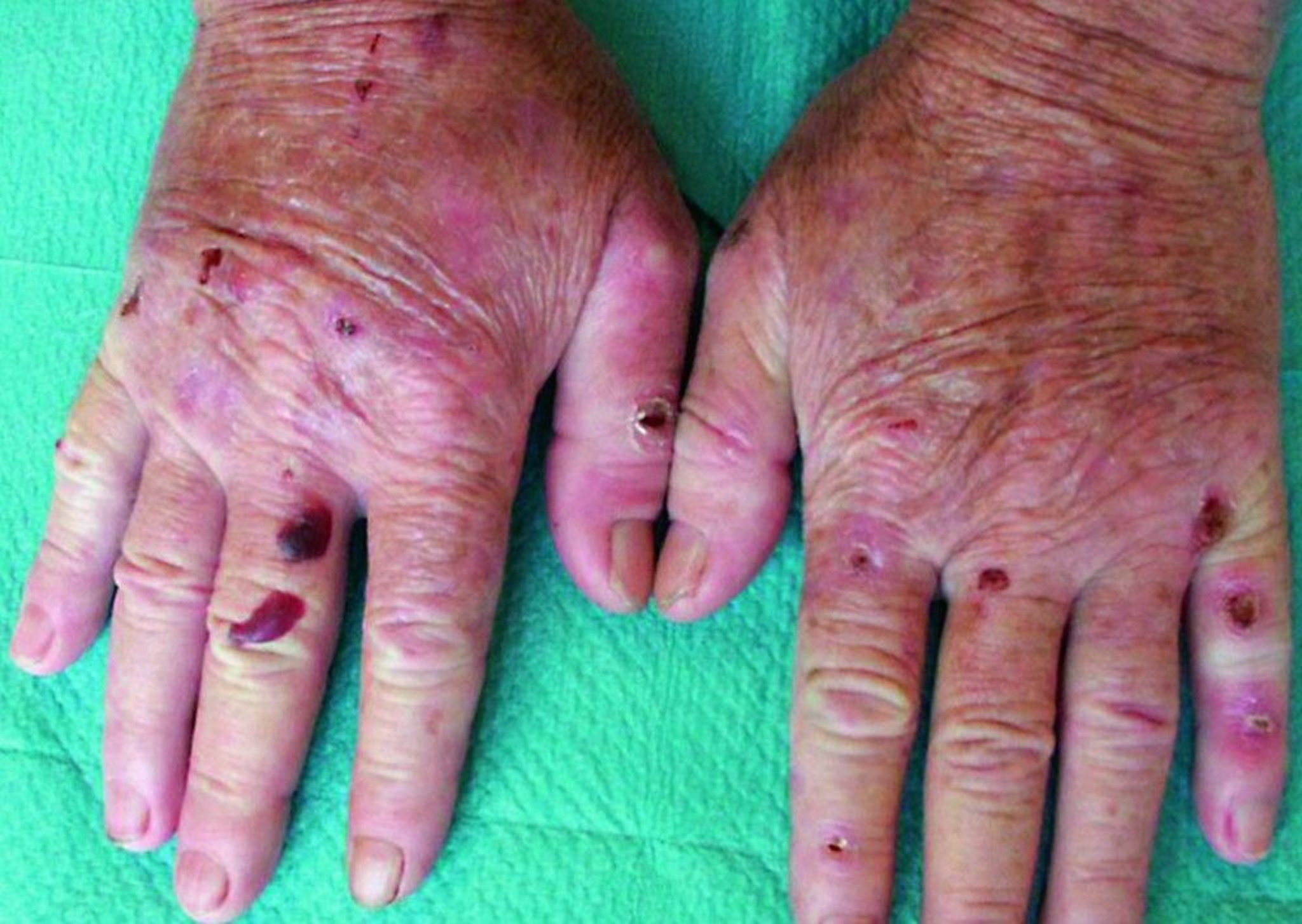 Porphyria Cutanea Tarda Kukiwa na Kovu