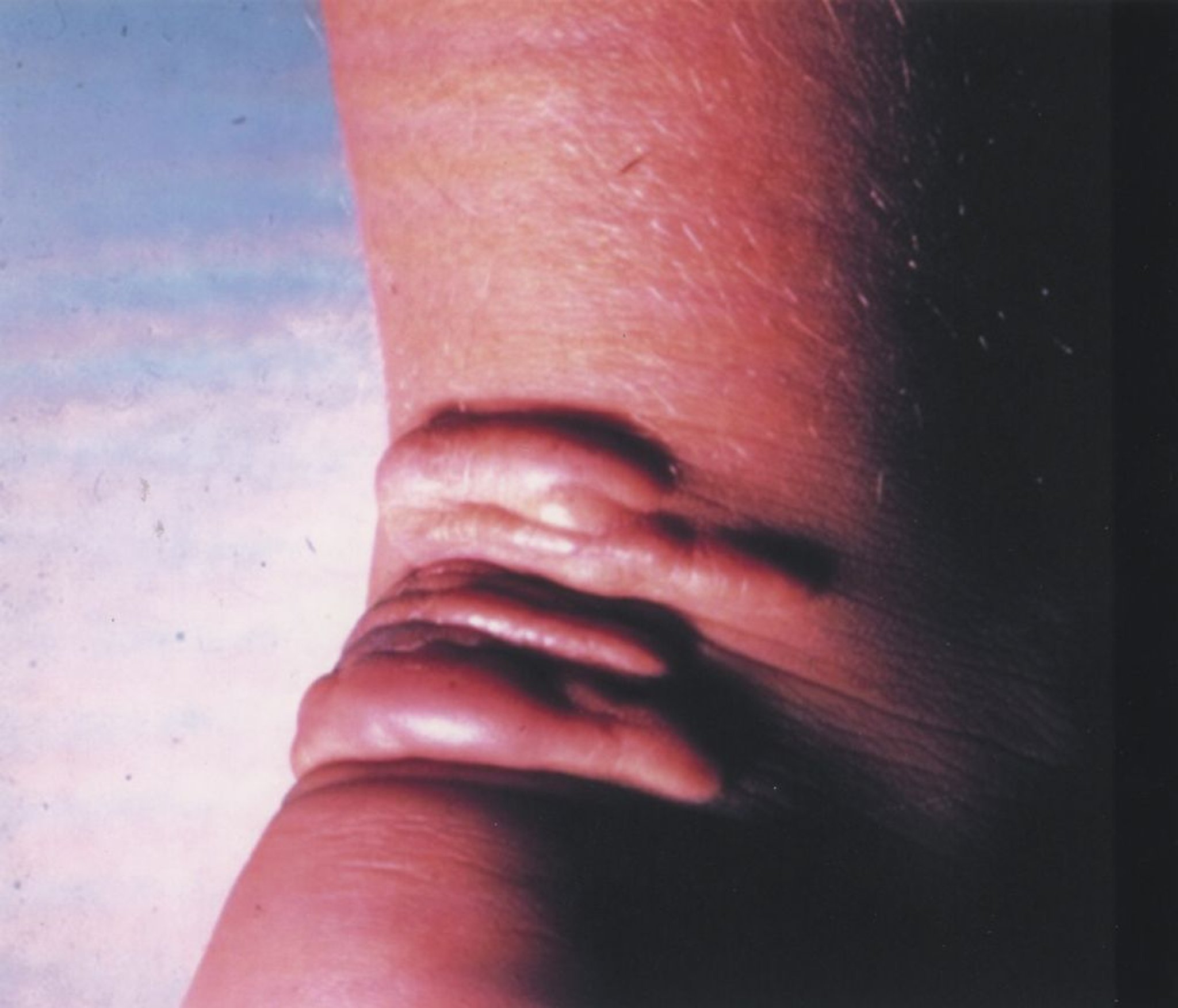 Xanthome sur le tendon d’Achille