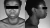 Graves Disease (Enlarged Thyroid Gland)