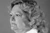 Exophthalmos (Bulging Eyes) in Graves Disease