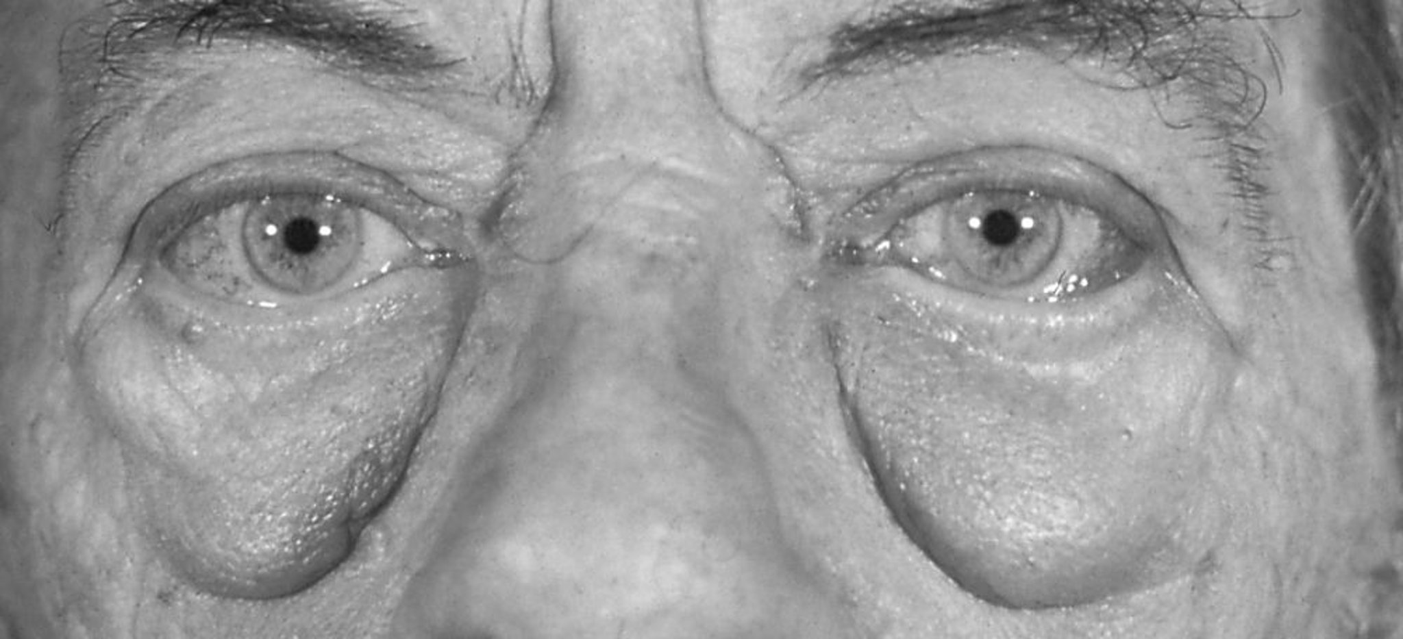 Geschwollene Augen bei Basedow-Krankheit