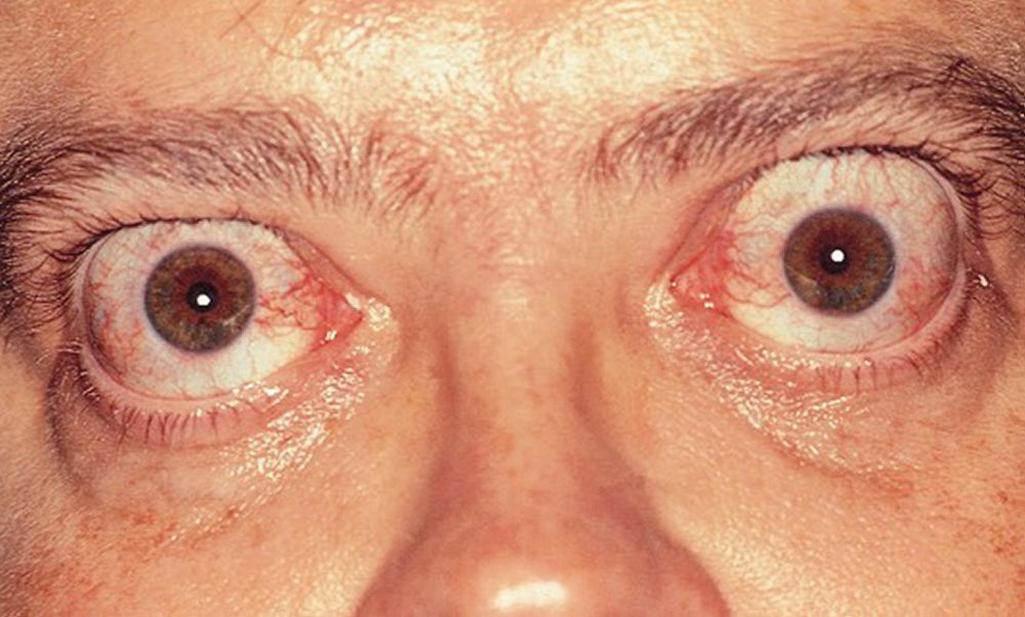 Abultamiento de un ojo (proptosis)