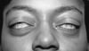 Inability to Close the Eyes in Graves Disease