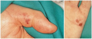 Endocardite infectieuse (peau)